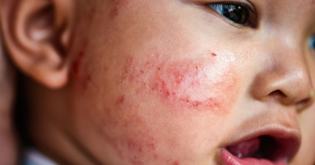 What Causes Eczema on Eyelids?